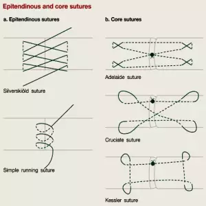 Tendon Sutures